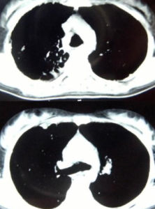 梅毒抗體 梅毒抗體