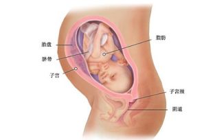 胎兒腎積水