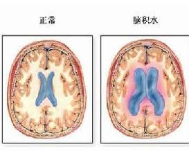 高原腦水腫 高原腦水腫