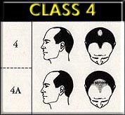 四級脫髮 四級脫髮