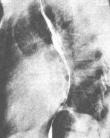 梅毒性主動脈瓣關閉不全