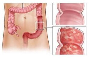 直腸黏膜慢性炎 直腸黏膜慢性炎