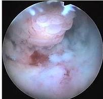 子宮內膜息肉 子宮內膜息肉