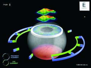 準分子雷射矯正手術 準分子雷射矯正手術