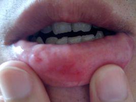 口唇紅腫 口唇紅腫