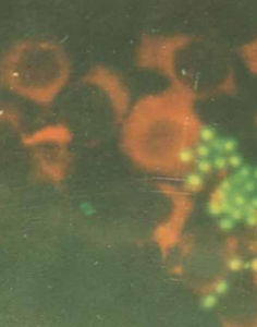 非淋菌性尿道炎 非淋菌性尿道炎