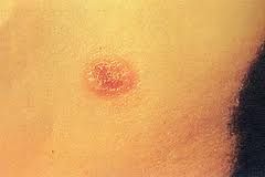 血孢子蟲病 血孢子蟲病