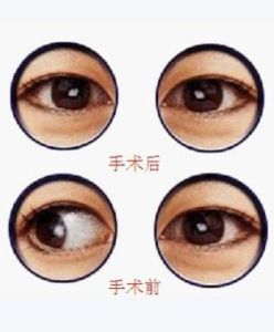 斜視眼 斜視眼