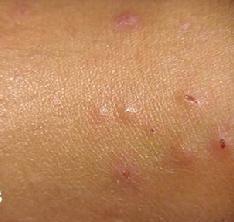 蟲咬皮炎 蟲咬皮炎