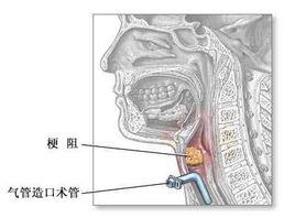 氣管造口術 氣管造口術