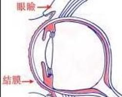 超急性細菌性結膜炎 超急性細菌性結膜炎