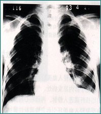 血行播散型肺結核