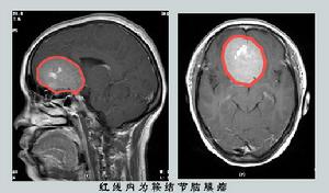 鞍結節腦膜瘤 鞍結節腦膜瘤