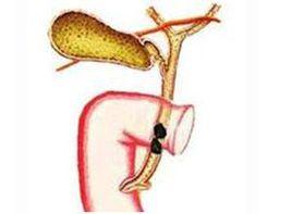 色素性膽結石 色素性膽結石