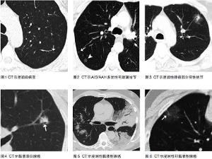 肺腺癌新分類