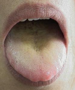 舌苔黃膩 舌苔黃膩