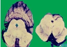 路易小體 路易小體