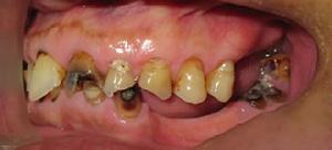 殘根殘冠 殘根殘冠