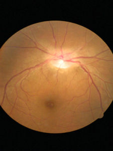 視神經炎 視神經炎