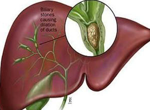 肝內膽管結石 肝內膽管結石