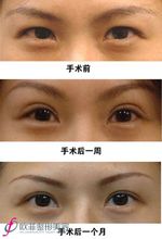 切開雙眼皮手術案例對比圖