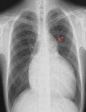 胸主動脈造影 胸主動脈造影