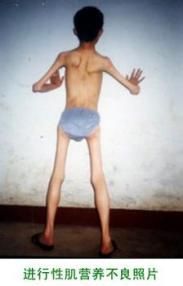 小兒面肩肱型肌營養不良 小兒面肩肱型肌營養不良