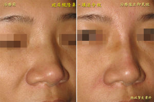 微晶瓷隆鼻術