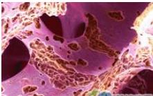 絕經後骨質疏鬆