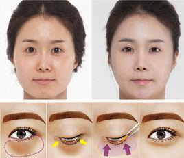 上瞼鬆弛整形術