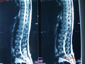 脊髓栓系綜合徵