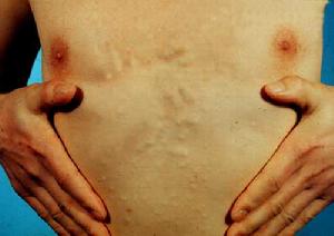 皮膚豬囊尾蚴病 皮膚豬囊尾蚴病