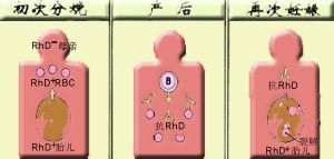 新生兒生理性黃疸