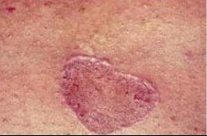 扁平苔癬 扁平苔癬