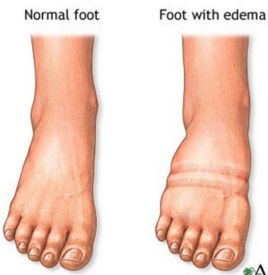 組織水腫 組織水腫