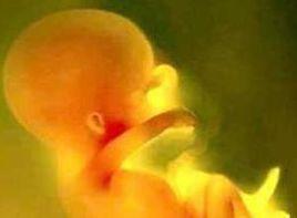 胎糞污染 胎糞污染