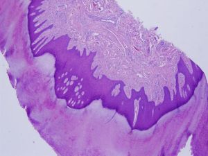 獲得性指 獲得性指