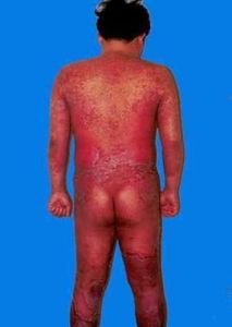 紅皮型銀屑病