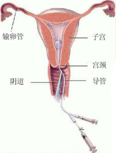 輸卵管導絲介入疏通術