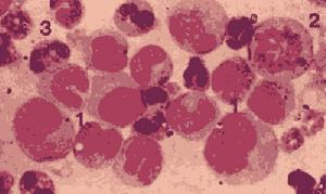 （圖）肥大細胞白血病