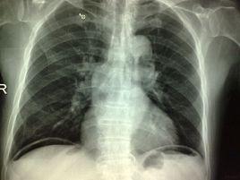 消化道穿孔 消化道穿孔