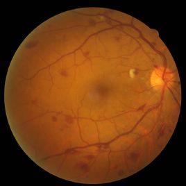 眼底黃斑病 眼底黃斑病