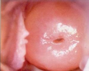 宮頸增生 宮頸增生