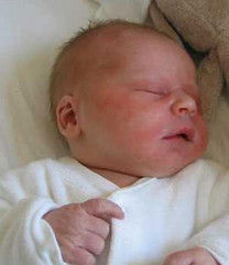 新生兒病理性黃疸 新生兒病理性黃疸