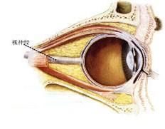 壓迫性視神經病變 壓迫性視神經病變