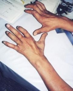 進行性延髓麻痹 進行性延髓麻痹