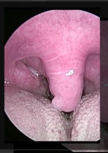 睡眠呼吸中止症