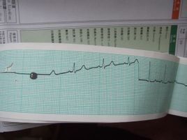 心電圖T波改變 心電圖T波改變