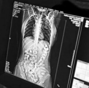 體內藏毒 體內藏毒