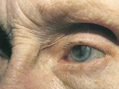 慢性進行性眼外肌麻痹 慢性進行性眼外肌麻痹